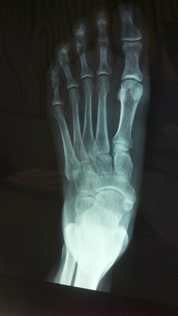 RTG chodidla: Co ukáže rentgen na nohou
